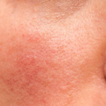Understanding Rosacea: Symptoms, Causes, and Effective Treatments