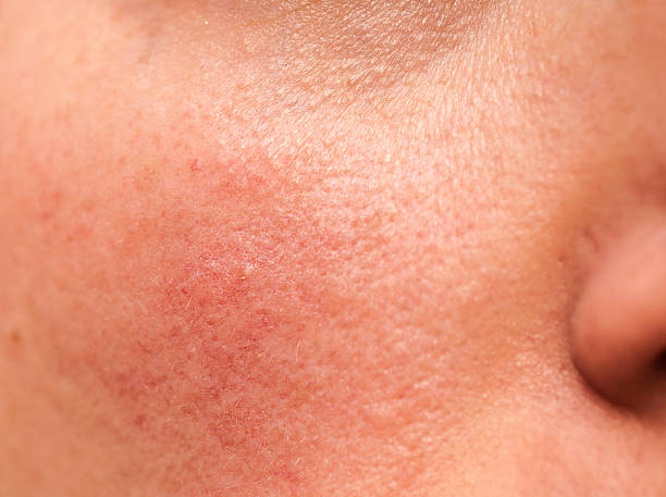 Understanding Rosacea: Symptoms, Causes, and Effective Treatments